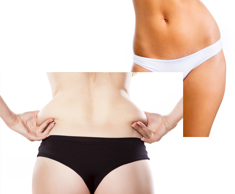 Liposuction